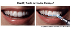 Natural Plus Tooth Whitening at Phuket Dental Clinic,Thailand